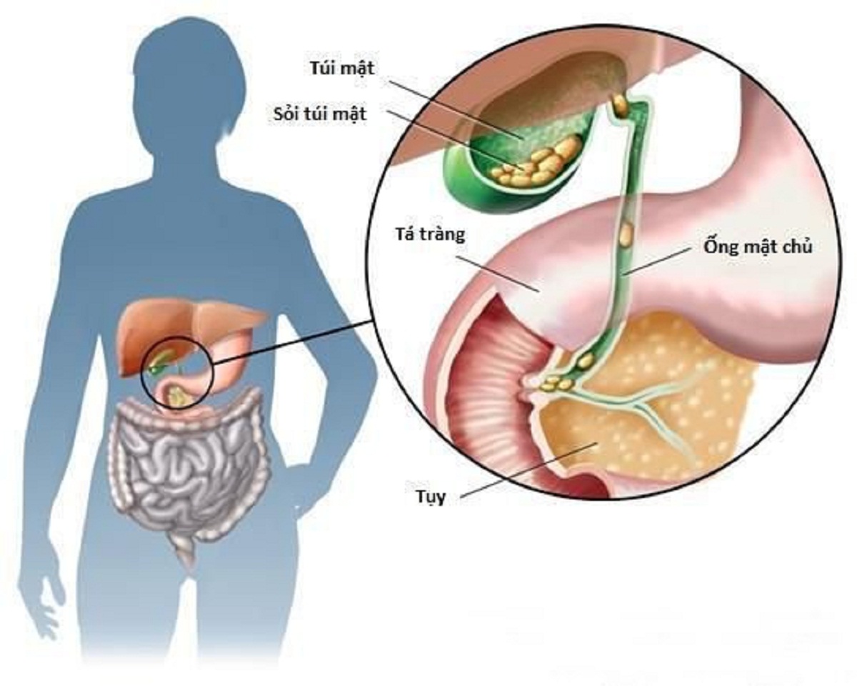 Bệnh sỏi mật có chữa được không và những vấn đề cần lưu ý