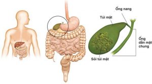 Bệnh sỏi mật và những điều cần biết khi điều trị bệnh sỏi mật