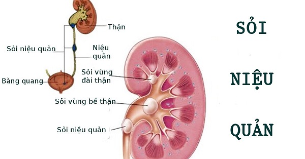 Bệnh sỏi niệu quản có nguy hiểm không?