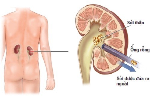 Bệnh suy thận giai đoạn đầu, phục hồi chức năng thận