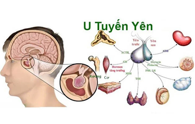 Bệnh suy tuyến yên có đáng lo ngại?