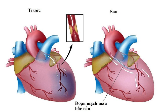 Bệnh tắc động mạch vành đe dọa sức khỏe, chớ chủ quan