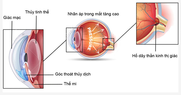 Bệnh tăng nhãn áp là gì? Điều trị như thế nào?