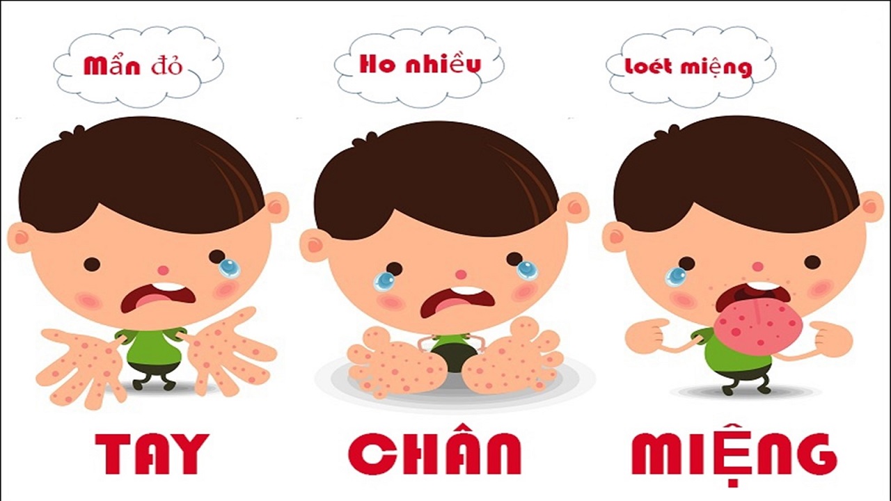 Bệnh tay chân miệng bao lâu thì khỏi?  Tìm hiểu về bệnh tay chân miệng