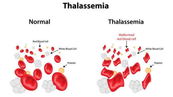 Bệnh Thalassemia (tan máu bẩm sinh) có nguy hiểm không?