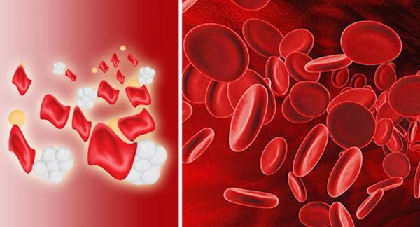 Bệnh thalassemia (tan máu bẩm sinh) khi nào cần đi khám?