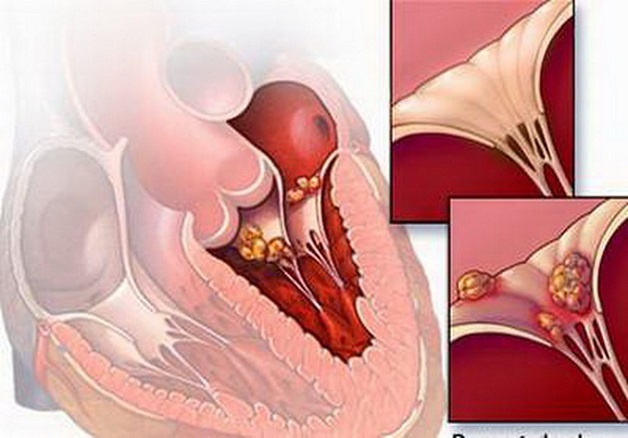 Bệnh thấp tim: Nguyên nhân, triệu chứng, cách phòng bệnh