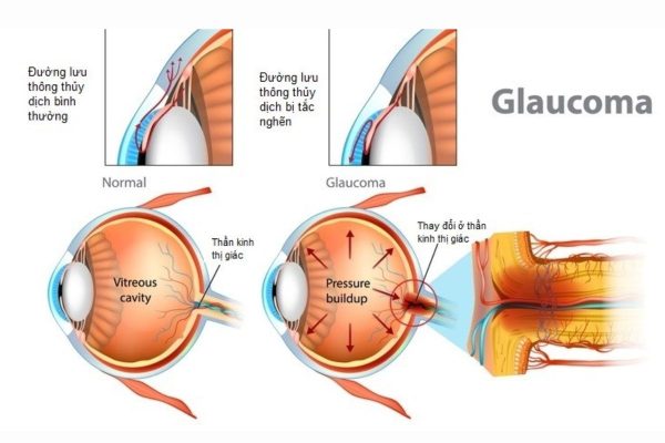 Bệnh thiên đầu thống: Dấu hiệu nhận biết và cách điều trị