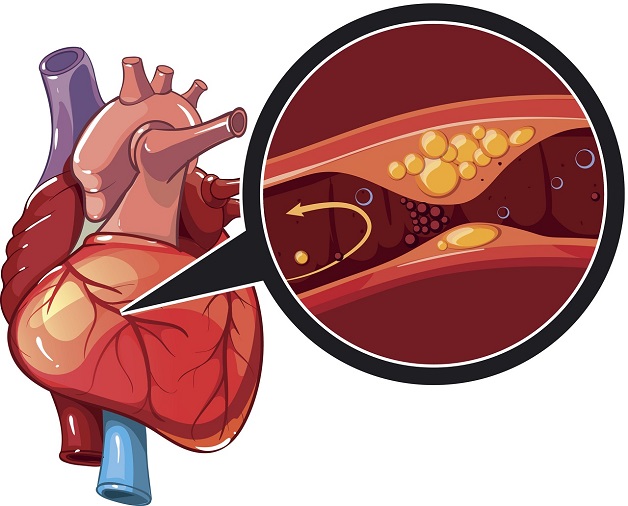 Bệnh thiếu máu cơ tim và nguy cơ biến chứng