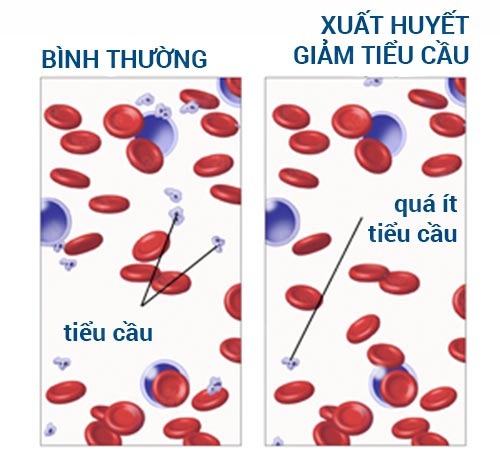 Bệnh thiếu tiểu cầu có nghiêm trọng không?