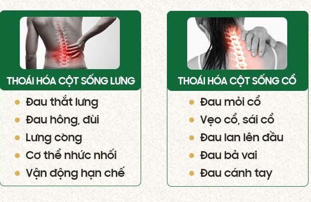 Bệnh thoái hóa cột sống: Nguyên nhân và triệu chứng bạn cần biết