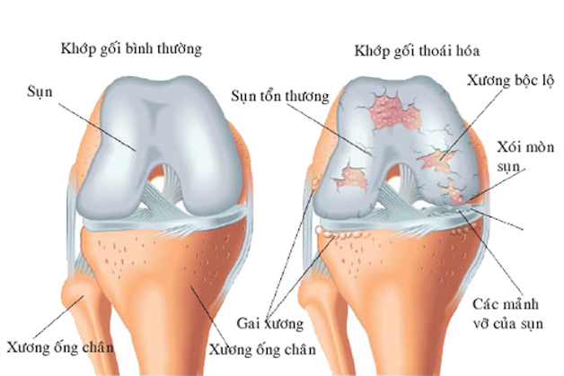 Bệnh thoái hóa khớp gối và cách điều trị hiệu quả