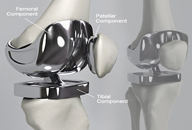 Bệnh thoái hóa khớp gối và cách điều trị hiệu quả