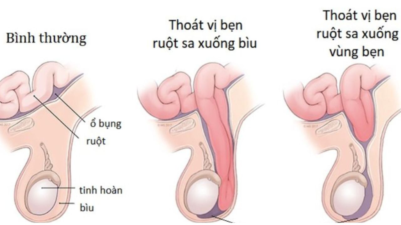 Bệnh thoát vị bẹn: nguyên nhân, triệu chứng và điều trị