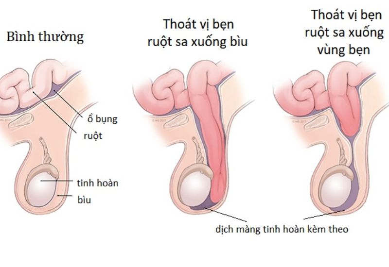 Bệnh thoát vị bẹn: nguyên nhân, triệu chứng và điều trị