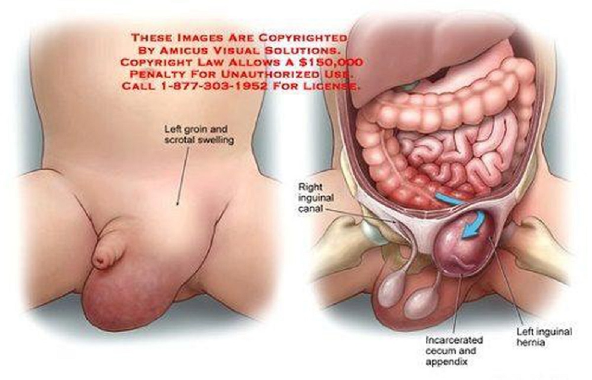 Bệnh thoát vị bẹn ở trẻ em: Biểu hiện và biến chứng