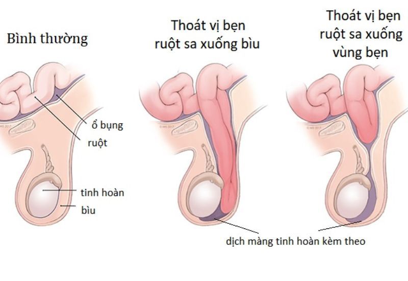 Bệnh thoát vị bẹn ở trẻ em đừng để đến khi “nghẹt” rồi cấp cứu