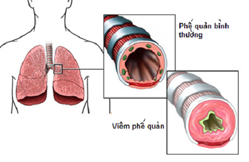 Bệnh thường gặp ở phổi khi chuyển mùa