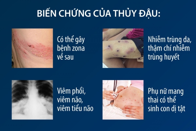  Bệnh thủy đậu lây lan nhanh, mẹ đã biết cách phòng cho bé?