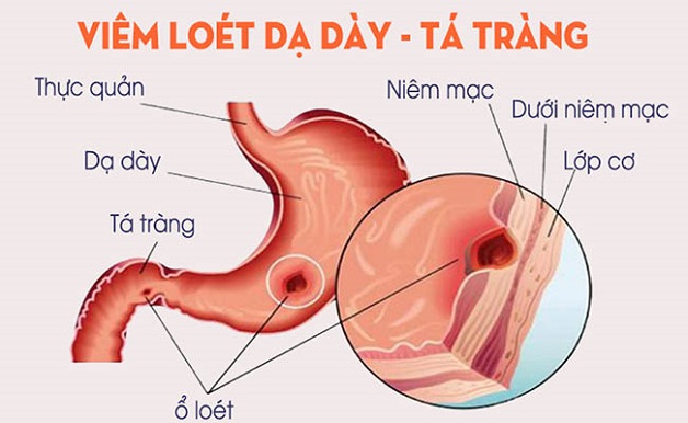 Bệnh tiêu hóa nên khám ở đâu và các bệnh phổ biến