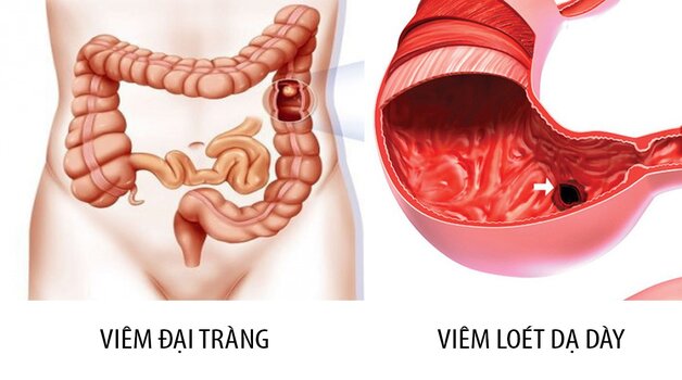 Bệnh tiêu hóa thường gặp và những điều cần quan tâm