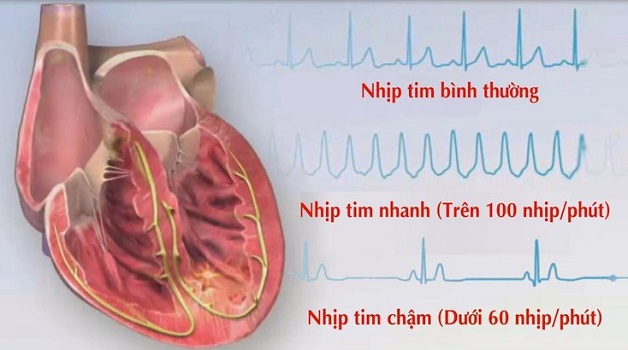 Bệnh tim đập chậm: Nguyên nhân, biểu hiện, điều trị