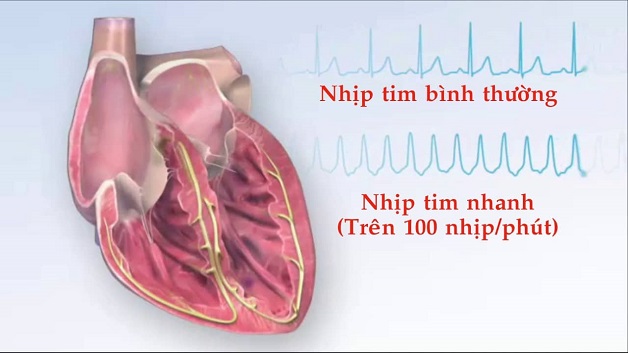 Bệnh tim đập nhanh là gì, có nguy hiểm không?