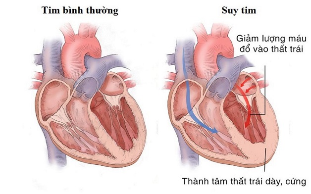 Bệnh tim khó thở có nguy hiểm không?