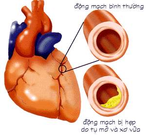 Bệnh tim mạch ở người cao tuổi