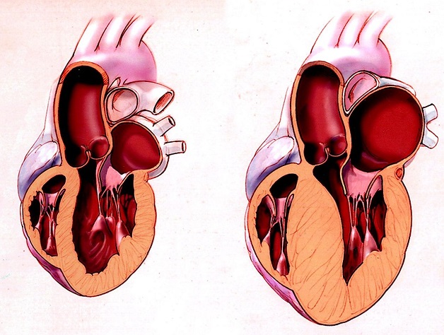 Bệnh tim to có nguy hiểm không? Triệu chứng và điều trị