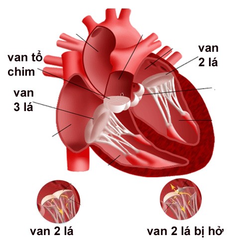 Bệnh tim van hai lá làm hạn chế lượng máu