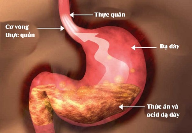 Bệnh trào ngược dạ dày: nguyên nhân, triệu chứng và cách phòng ngừa