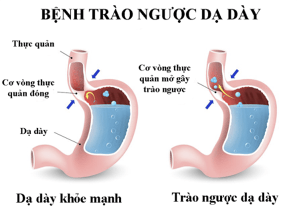 Bệnh trào ngược dạ dày thực quản có nguy hiểm không?