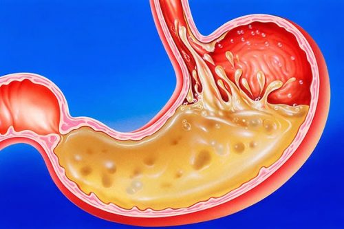 Bệnh trào ngược dạ dày thực quản ở người lớn