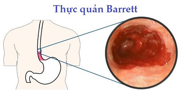 Bệnh trào ngược dạ dày thực quản và sự nguy hiểm của nó