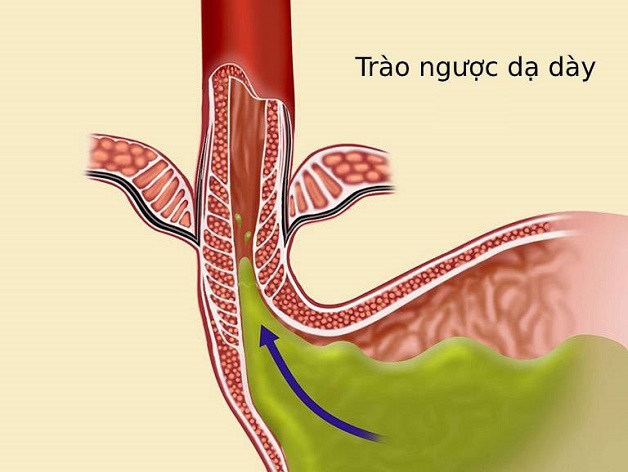 Bệnh trào ngược dạ dày – Triệu chứng, nguyên nhân