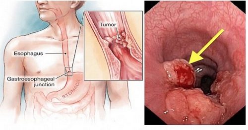 Bệnh trào ngược dễ gây ung thư thực quản