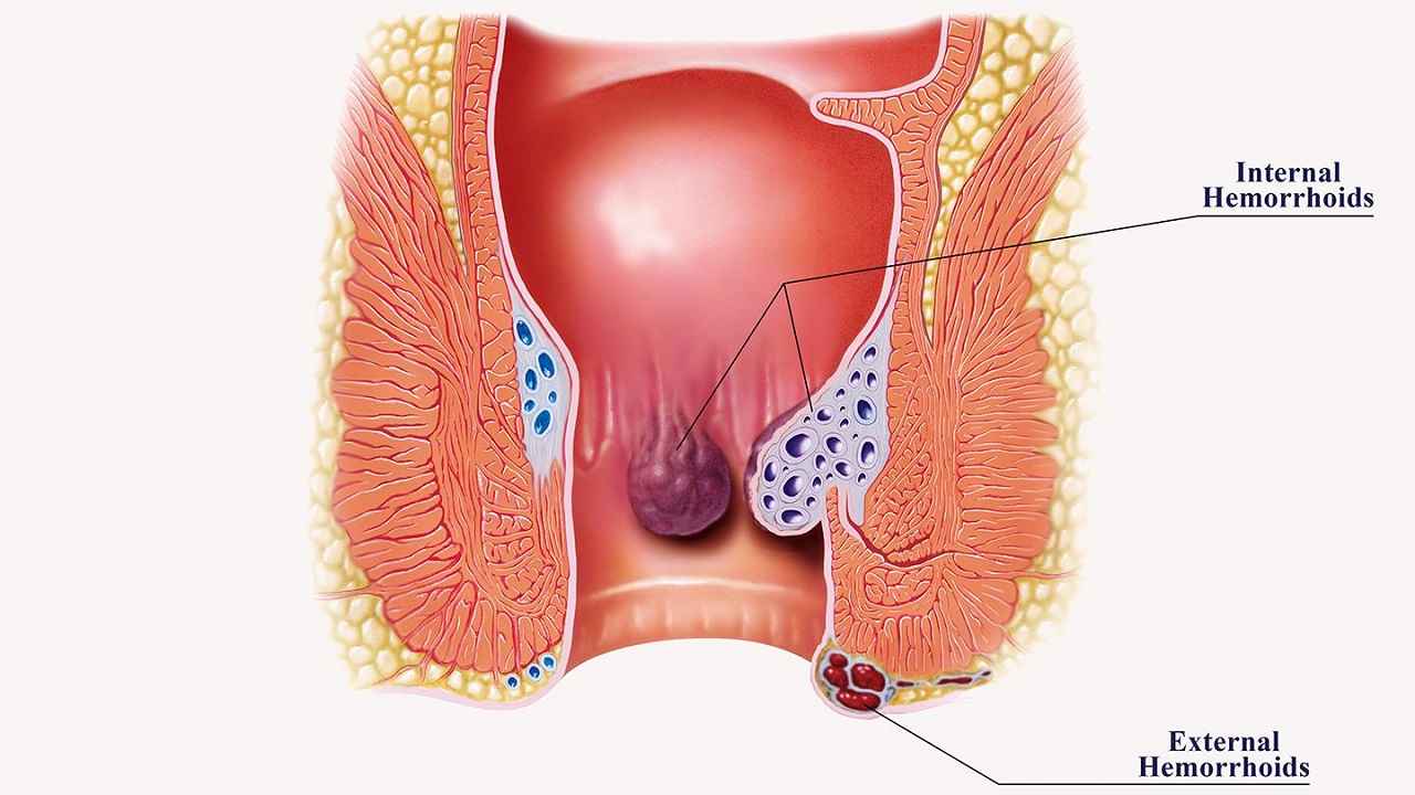 Bệnh trĩ cấp độ 4 nguy hiểm như thế nào?