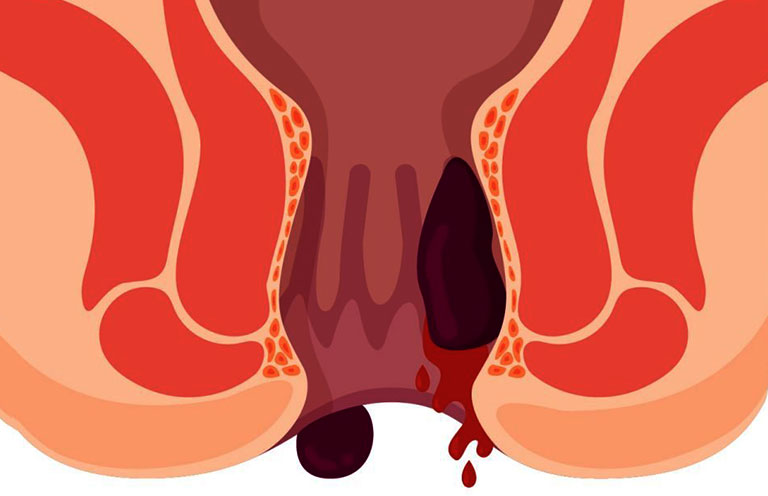 Bệnh trĩ chảy máu điều trị thế nào? – Góc giải đáp