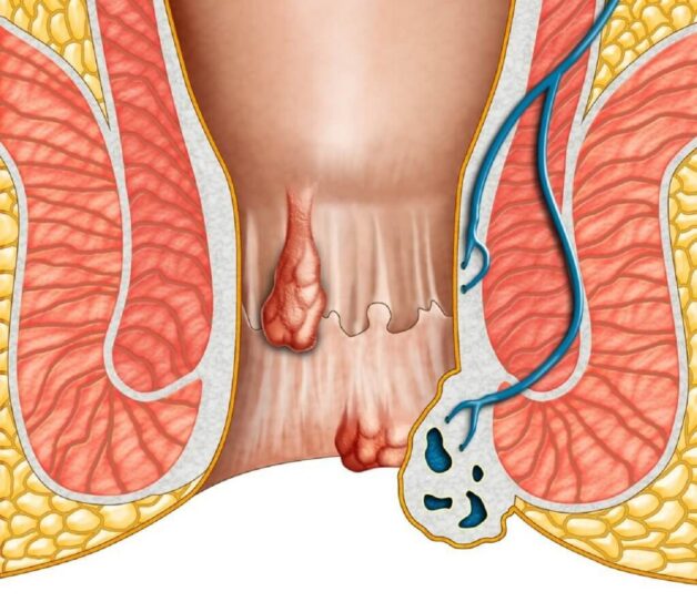 Bệnh trĩ có ảnh hưởng đến quan hệ không – những điều cần biết