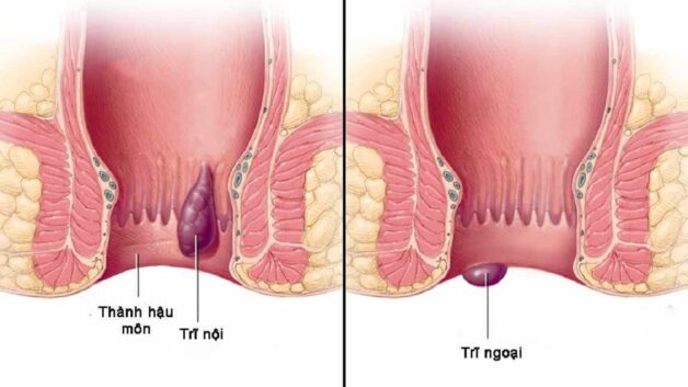 Bệnh trĩ có chơi thể thao được không: Giải đáp và gợi ý