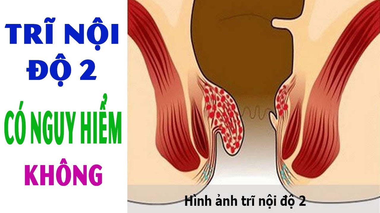 Bệnh trĩ độ 2 và các thông tin cần biết