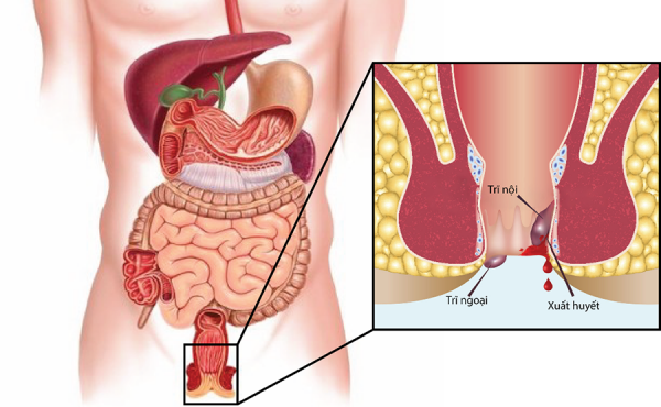 Bệnh trĩ giai đoạn đầu: Nhận biết sớm – Điều trị dễ dàng hơn