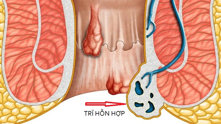 Bệnh trĩ hỗn hợp và những điều cần biết