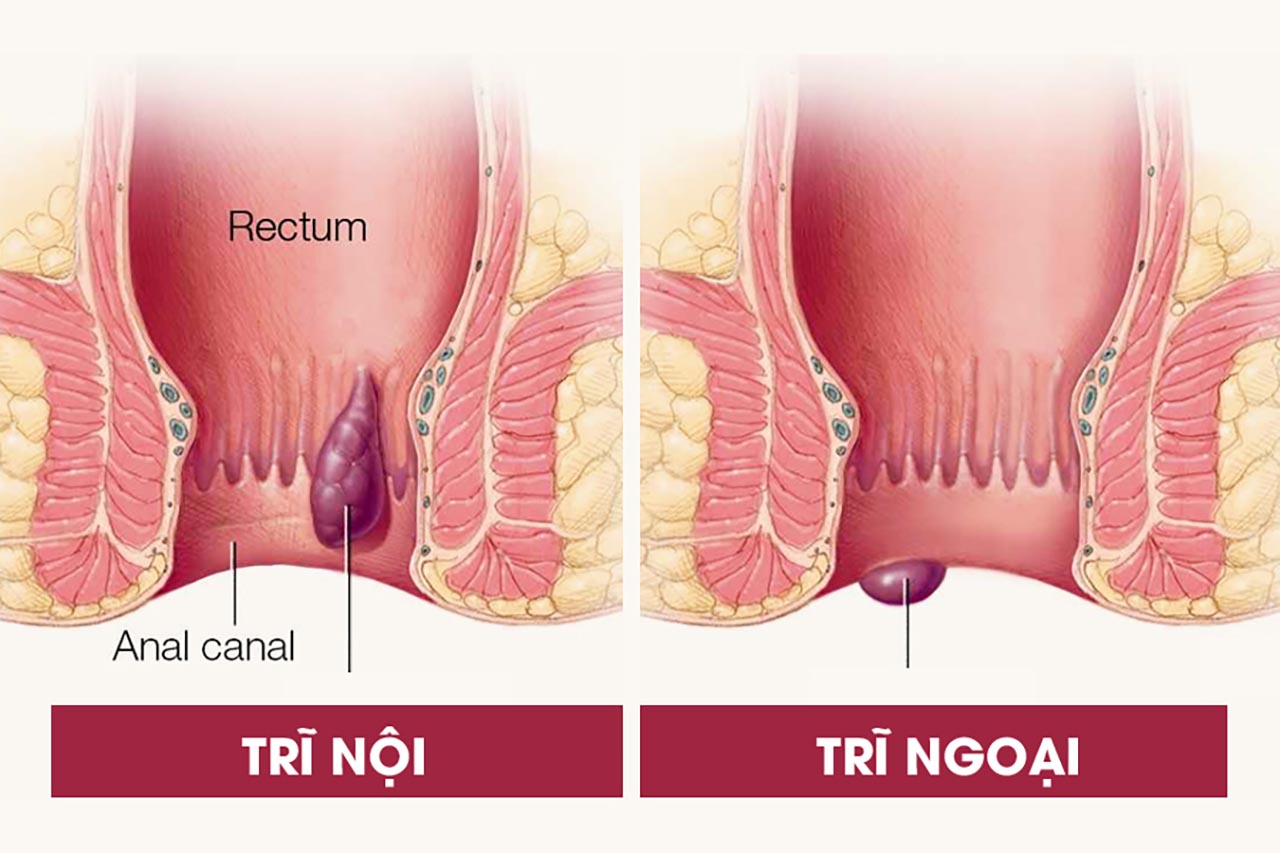 Bệnh trĩ khám ở đâu – Góc giải đáp