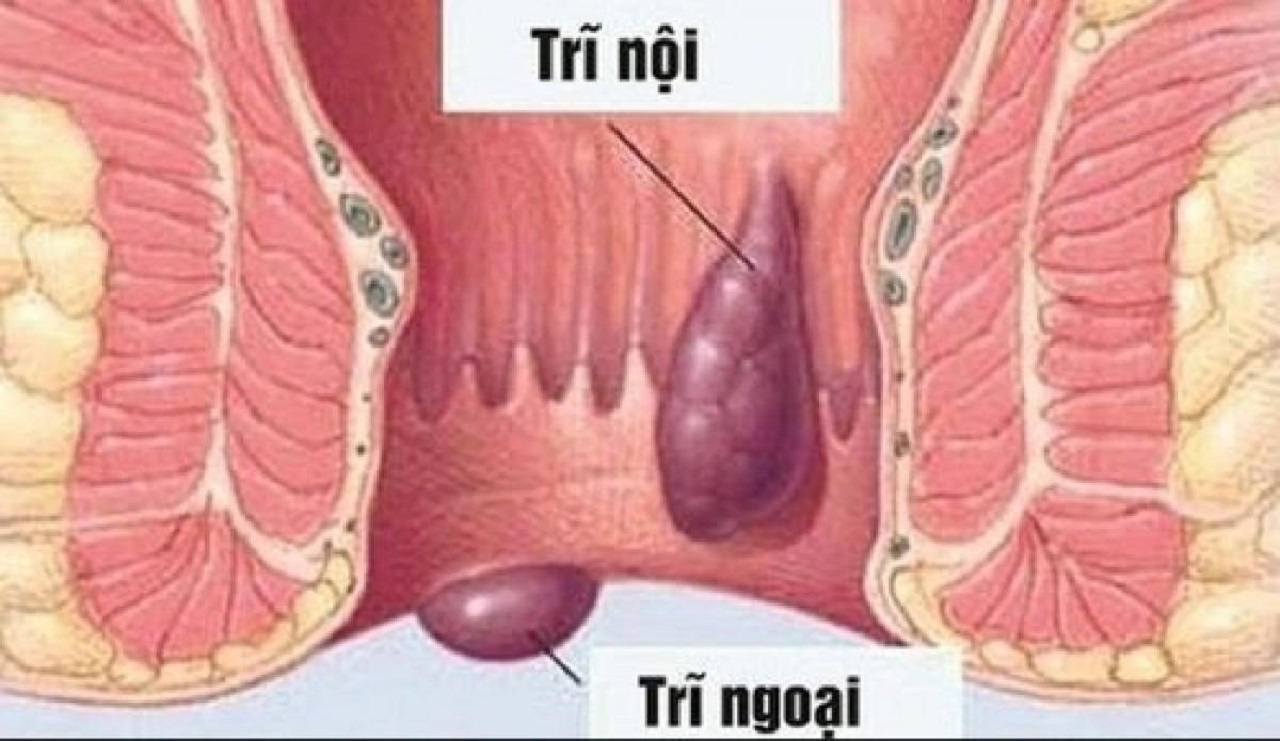 Bệnh trĩ khi nào cần phẫu thuật?