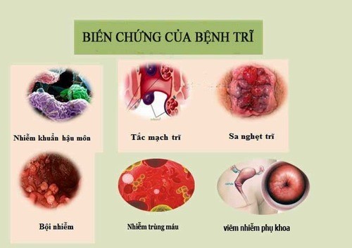 Bệnh trĩ khi nào cần phẫu thuật?