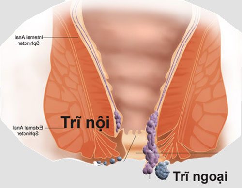 Bệnh trĩ là gì? Nguyên nhân, triệu chứng, điều trị