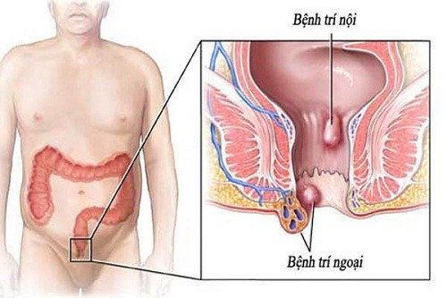 Bệnh trĩ ngoại – bạn cần biết những gì?