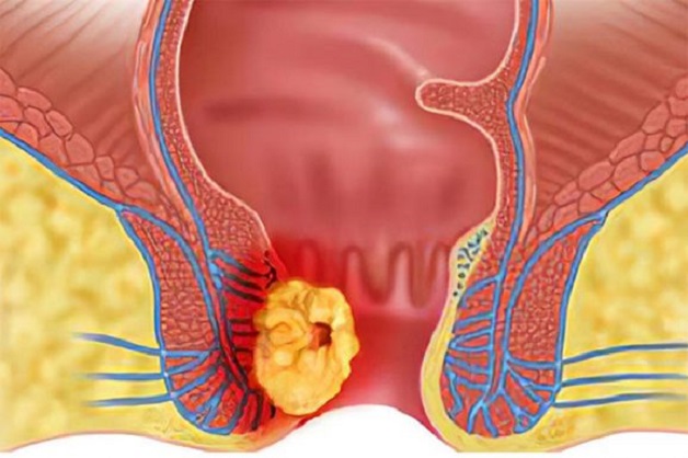 Bệnh trĩ ngoại cấp độ 4: những điều cần biết